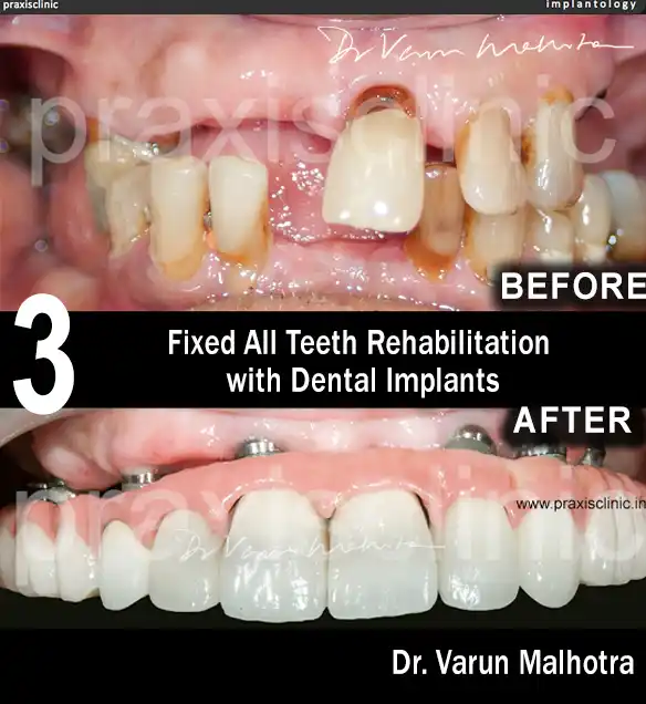 Full Mouth All-on-8 Implant by the best dentist for dental implants in Mumbai 