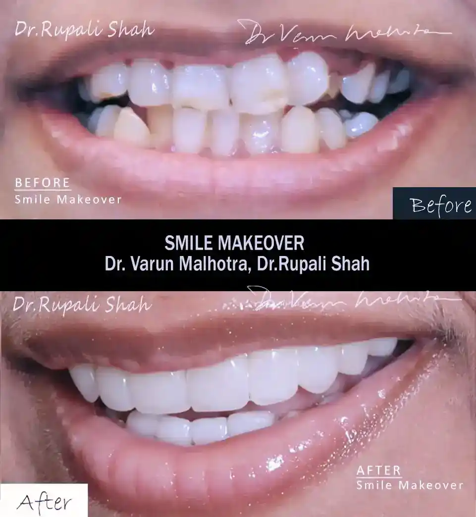 Implant-Supported Overdenture by the best dentist for dental implants in Mumbai 