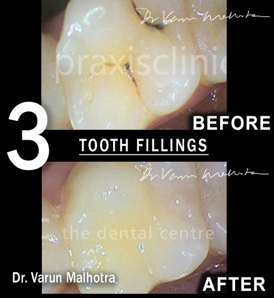 Implant-Supported Overdenture by the best dentist for dental implants in Mumbai 