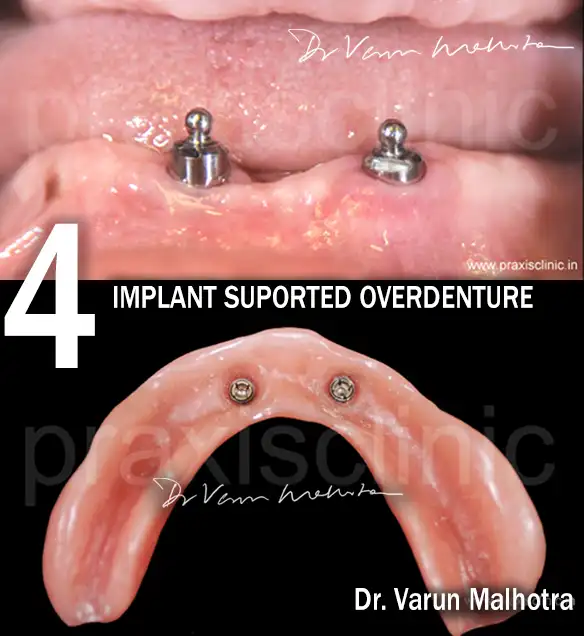 Implant-Supported Overdenture by the best dentist for dental implants in Mumbai 