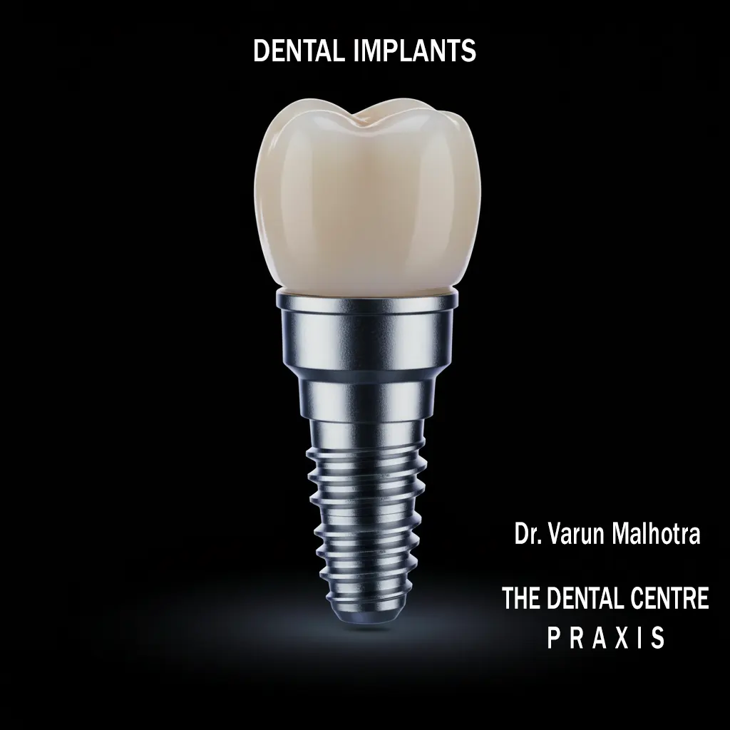Single tooth implant with a ceramic crown by the best dentist for dental implants in Mumbai