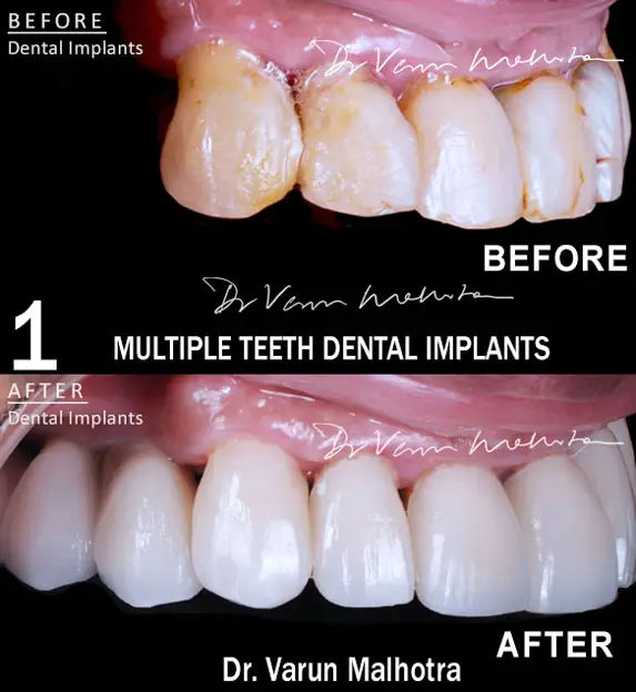 Multiple Teeth Implant-Supported Bridge with a ceramic crowns by the best dentist for dental implants in Mumbai