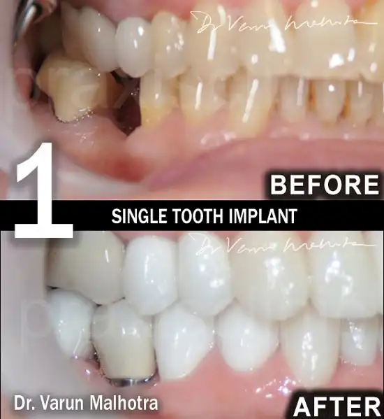 Single tooth implant with a ceramic crown by the best dentist for dental implants in Mumbai