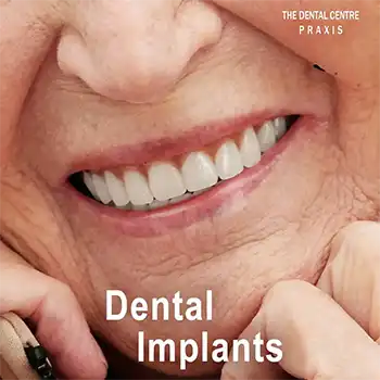 Implant-Supported Overdenture by the best dentist for dental implants in Mumbai 