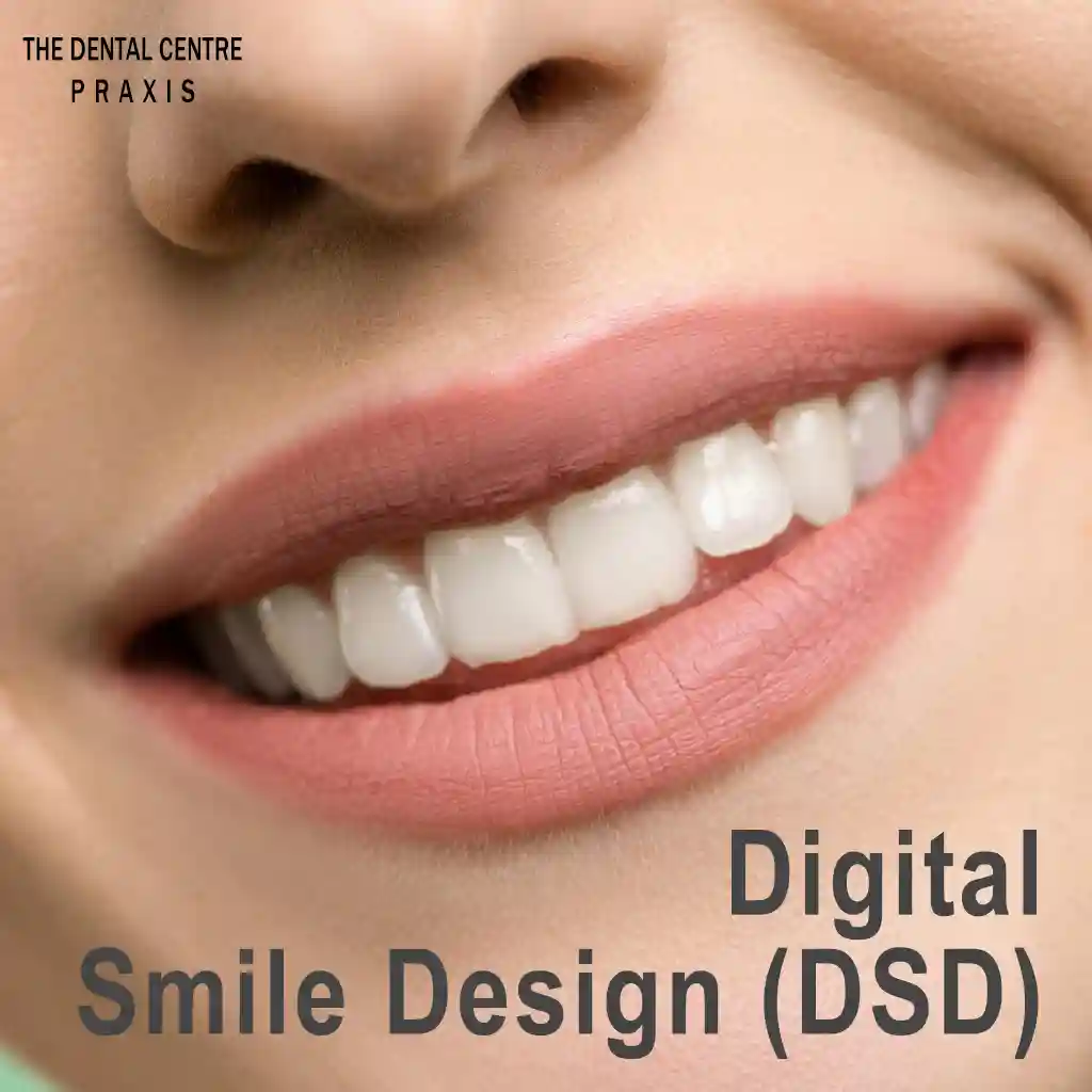 Multiple Teeth Implant-Supported Bridge with a ceramic crowns by the best dentist for dental implants in Mumbai